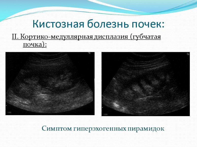 Кистозная болезнь почек: II. Кортико-медуллярная дисплазия (губчатая почка):      